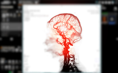 CTA Brain Vascular Imaging:.This image highlights a detailed 3D CTA scan of the brain’s vascular network, showing clear visualization of arteries and blood flow for diagnostic purposes.