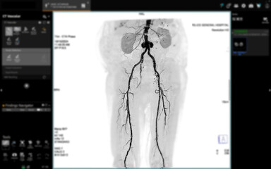 3D CTA of Lower Extremities:.A clear 3D visualization of the femoral artery and lower body skeleton, supporting vascular and orthopedic assessment.