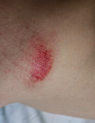 Fototapeta premium Bruise on skin showing redness and irritation from recent impact or injury concept