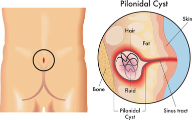 Medical illustration of pilonidal cyst, with annotations.
