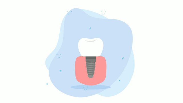 Dental Implant or Artificial prosthetic tooth root animation, Replace Single titanium screwed teeth animated video, Dentistry clip, Oral Healthcare footage, Dental treatment instrument motion graphics