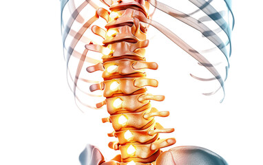 Fototapeta premium Medical Diagram Highlighting Dislocated Vertebra Isolated on Transparent Background PNG.
