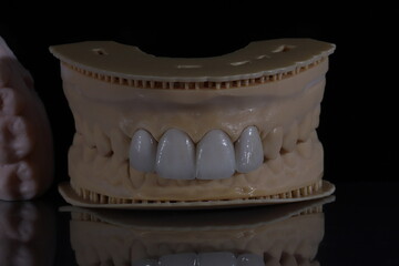 Dental aesthetics in dentistry with digital smile design treatment. Computer assisted jaw and mouth model with glass-ceramic porcelain laminate veneers. E-Max leaf porcelain dental crowns.  © UniqDream