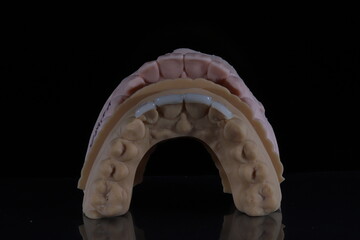 Dental aesthetics in dentistry with digital smile design treatment. Computer assisted jaw and mouth model with glass-ceramic porcelain laminate veneers. E-Max leaf porcelain dental crowns.  © UniqDream