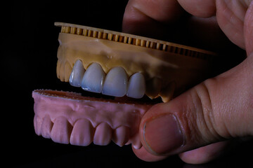 Dental aesthetics in dentistry with digital smile design treatment. Computer assisted jaw and mouth model with glass-ceramic porcelain laminate veneers. E-Max leaf porcelain dental crowns.  © UniqDream