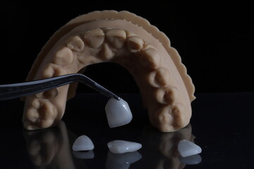 Aesthetic smile design treatment in dental dentistry. Dental laminate veneers and computer-assisted jaw and mouth model mockup with porcelain laminates.  © UniqDream