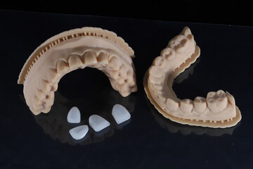 Dental laminate veneers with a jaw model prepared using digital smile design in aesthetic dentistry. Porcelain, zirconia, and E-Max dental crowns. smile makeover.  © UniqDream