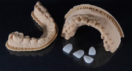 Dental laminate veneers with a jaw model prepared using digital smile design in aesthetic dentistry. Porcelain, zirconia, and E-Max dental crowns. smile makeover.  © UniqDream
