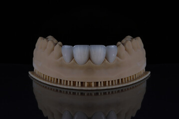 Dental laminate veneers with a jaw model prepared using digital smile design in aesthetic dentistry. Porcelain, zirconia, and E-Max dental crowns. smile makeover.  © UniqDream