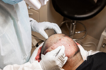 Doctor performing hair transplant. Surgeons in the operating room carry out hair transplant surgery.