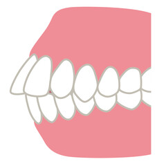 歯が出た歯並び　口ゴボ　歯列矯正