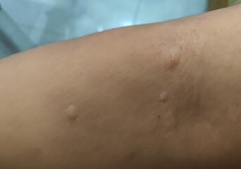 Fototapeta premium Itchy skin due to mosquito bites.