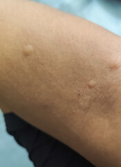 Fototapeta premium Itchy skin due to mosquito bites.