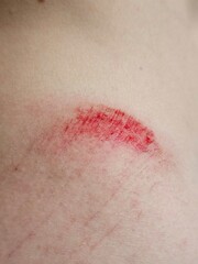 Fototapeta premium Unhealed wound with visible redness and irritation