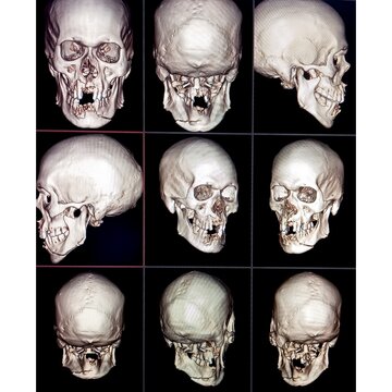 3d reconstruction computer tomography or CT scan image showing severe fracture of the face after an accident. Teeth and mandible fracture.