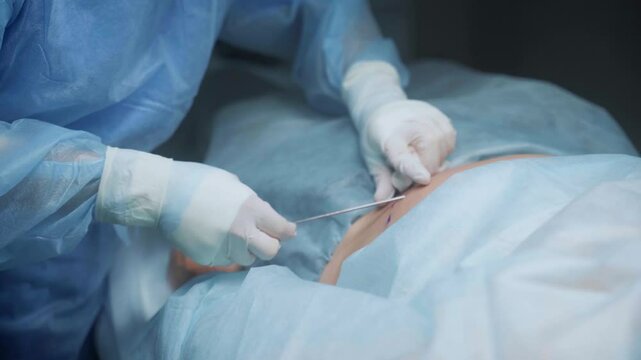 A skilled surgeon performs liposuction on a patient in a sterile clinical environment, focusing on technique and ensuring patient comfort throughout the process.