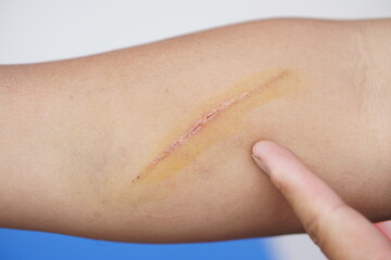 Fototapeta premium Scratch wound on arm skin. Concept, physical injury from accident. It can be scar on skin after it's dry.