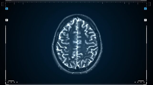 Brain MRI scan. Scanning of brain's magnetic resonance image. Diagnostic Medical Tool.