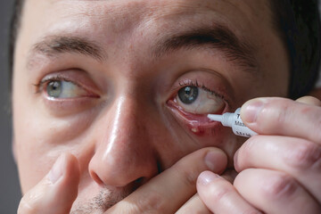 Close up of man's infected chalazion (stye, barley) or hordeolum eye with ointment. Viral Infection. Staphylococcus. Ophthalmology