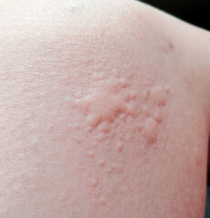 Fototapeta premium The Huge Urticaria allergy symptoms on Skin
