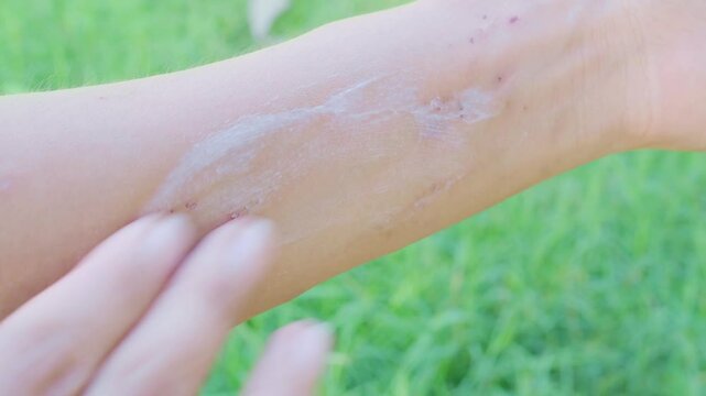 Woman apply calamine lotion , hand with urticaria allergy Itchy rash Eczema Itch woman from food, air poisoning,cosmetic,health,body care disease lilness air.