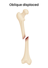 Causes of Oblique Displaced Fracture