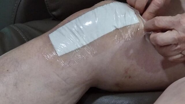 open plaster waterproof the wound for protect long scar and gash bruise on leg after surgery knee arthroplasty osteoarthritis. old retirement women patient recovery skin