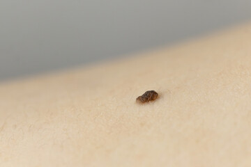 A close-up of a mole on the skin
