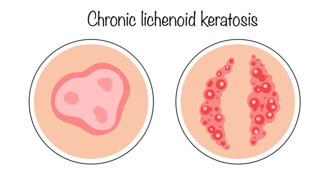 Chronic lichenoid keratosis