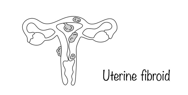 Uterine fibroid
