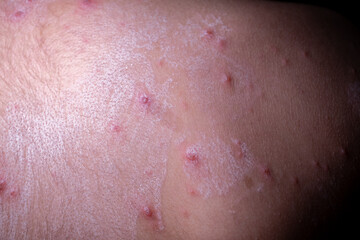 Fototapeta premium Closeup of Chickenpox Symptoms on Human Skin