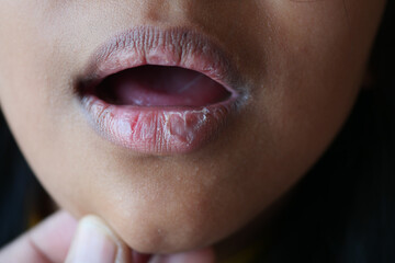 close up of dry lip of a child 