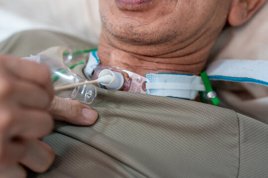 Patients who have undergone a tracheostomy for intubation