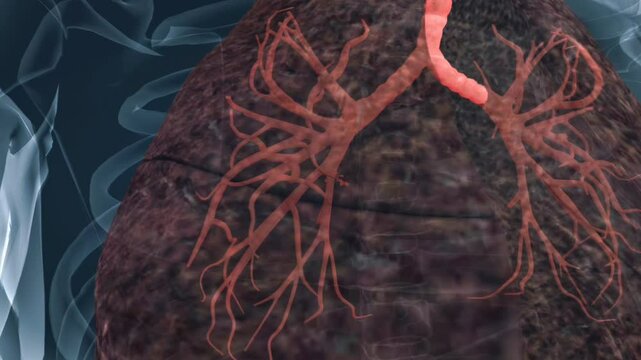  COPD,Chronic bronchitis and pulmonary emphysema