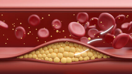 Cholesterol buildup in arteries, blocking blood flow, heart attack risk.