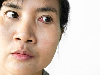 Obraz premium Pterygium cataract eyes inflammation after peel off the pterygium, medical inject drug into lesion eyes blood vessel, doctor medicine for health 7 days after surgery.