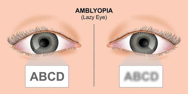 Amblyopia Lazy Eye illustration