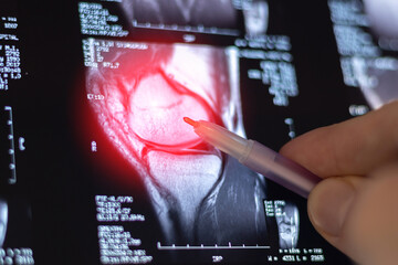 Doctor learning Knee joint MRI. Assessing ligaments, cartilage, and identifying issues like tears...