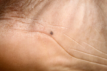 Fototapeta premium close up of mole on sole of foot of man