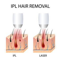 IPL (Intense Pulsed Light) and Laser Hair Removal. Differences in Hair Removal, Skin Conditions During Treatment Session