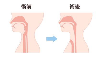 喉頭癌の術前術後の気管のイラスト