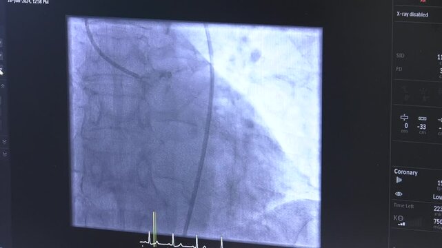 Coronary angiogram, medical x-ray for heart disease. Coronary artery disease. Selective focus finger point lesion of right coronary artery on x-ray monitor