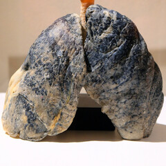 Evidence of damage on smoker lungs 