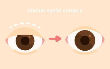 double eyelid surgery blepharoplasty plastic surgery