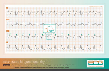 In a wide QRS rhythm, the nature of the P wave can be observed in leads with lower QRS wave amplitudes. In this case, retrograde P waves can be seen in leads aVR and aVL.