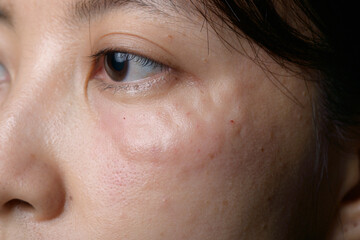 Obraz premium Close up of Asian woman face showing skin swelling and redness near cheek area