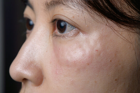 Close up of Asian woman face showing skin texture and swelling under eye