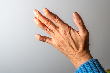 Senior woman showing deformed fingers from arthritis