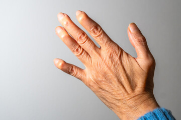 Senior woman showing deformed fingers from arthritis