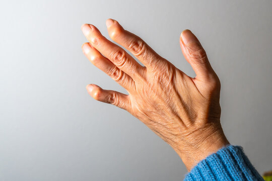 Senior woman showing deformed fingers from arthritis